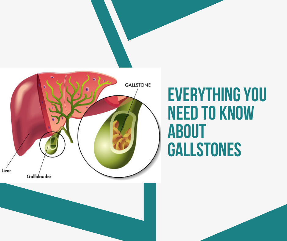 Everything You Need to Know About Gallstones